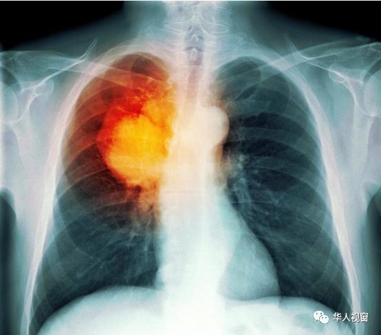 胃癌这么恐怖，为什么日本治疗胃癌效果这么好？